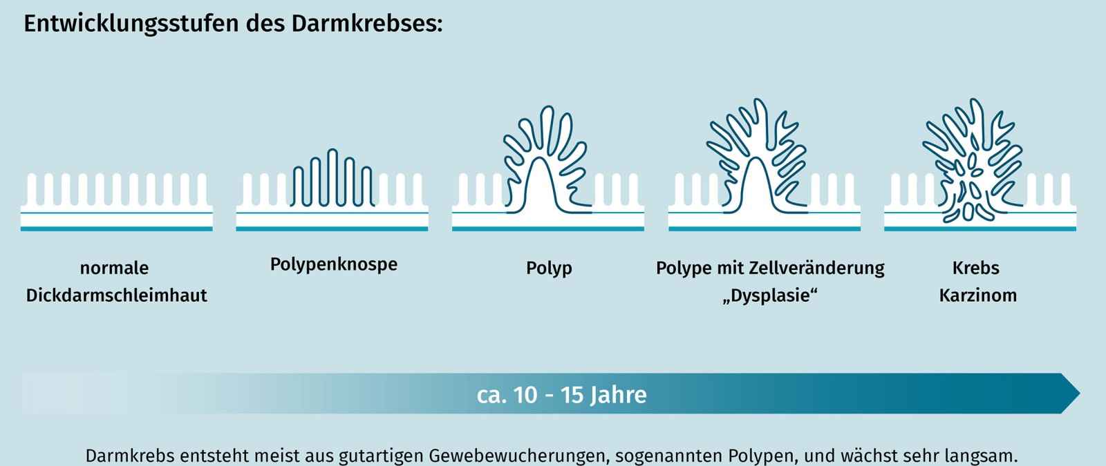 Entwicklungsstufen des Darmkrebses