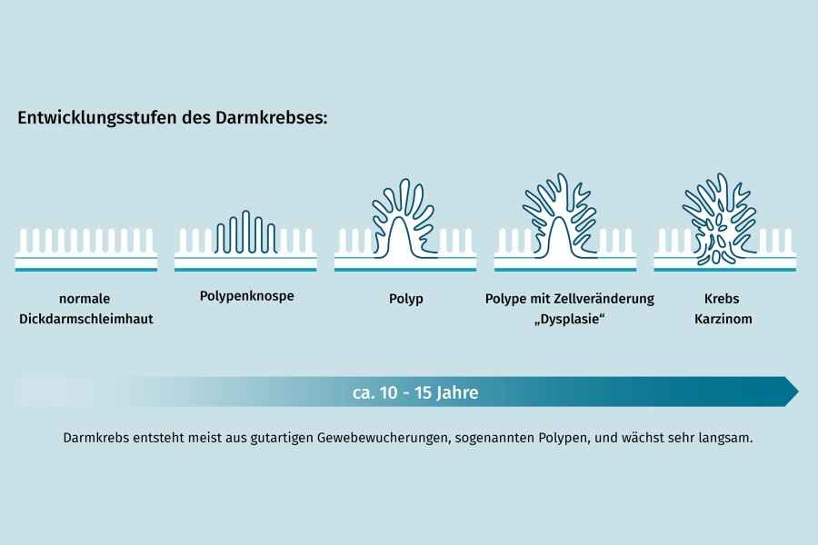Entwicklungsstufen des Darmkrebses